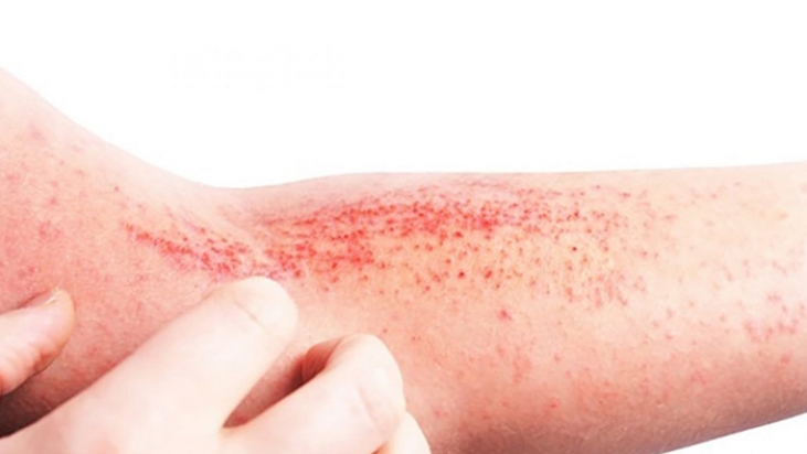 Día Mundial de la Dermatitis Atópica